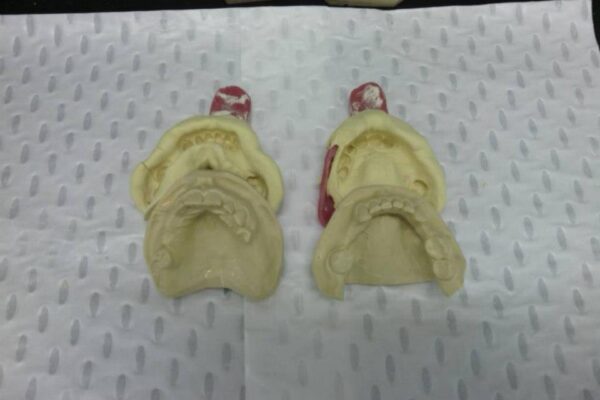 mouthguard cast