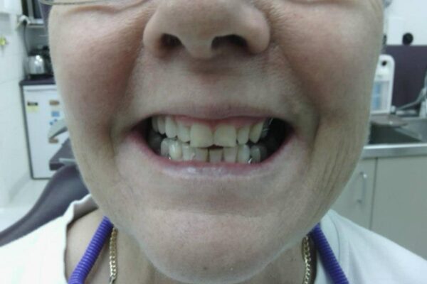 denture adjustments