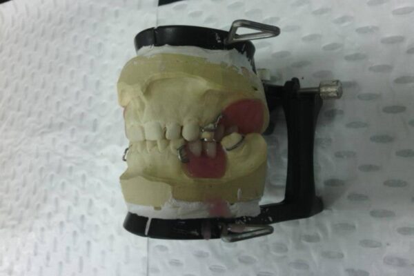 partial denture cast