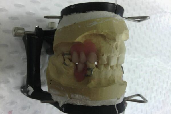 partial denture fitting