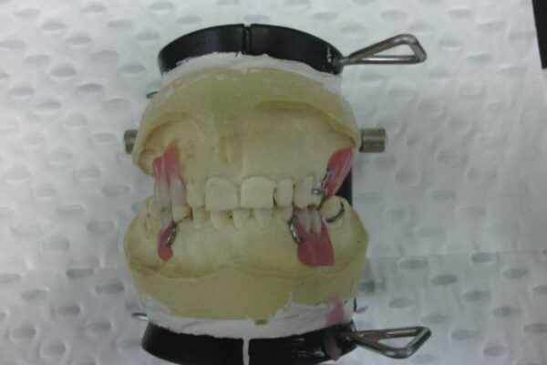 Dental cast with partial denture